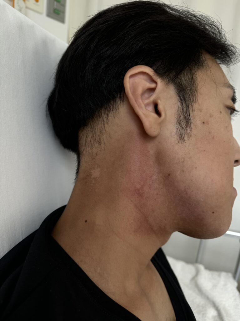 中咽頭がんで入院時③（＠manoteprojectさんより提供）