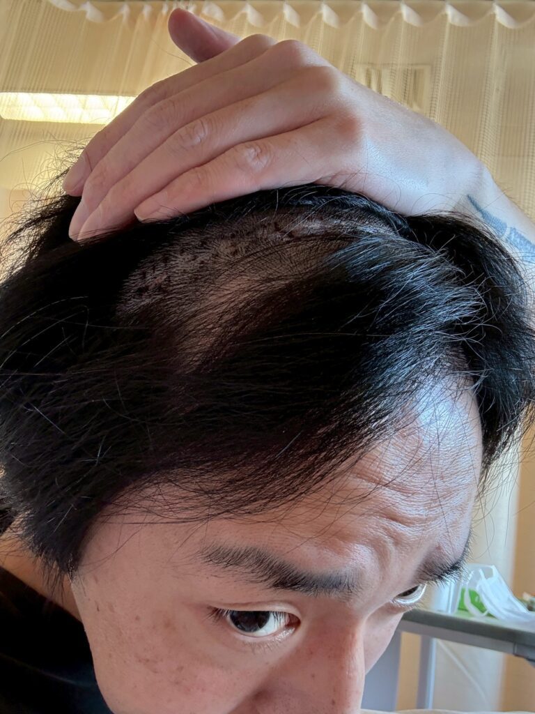 脳腫瘍摘出後②（＠manoteprojectさんより提供）