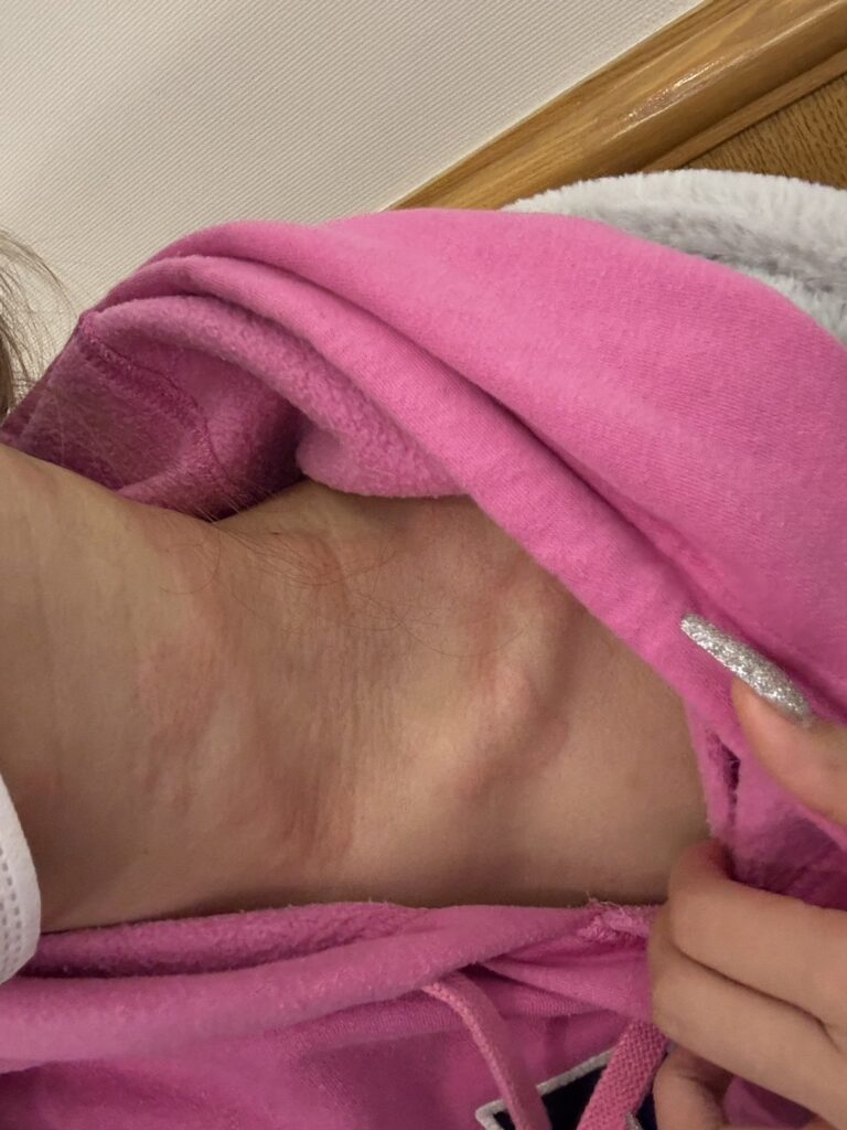 【実際の写真】　腫れた顔の様子