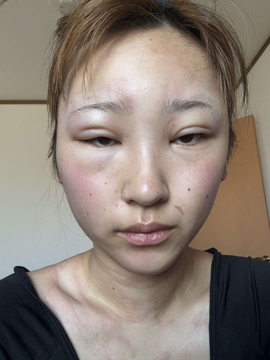 インフルかと思ったら、突如顔が腫れ始めて…→その後、受けたまさかの診断結果とは 現在の様子に迫る