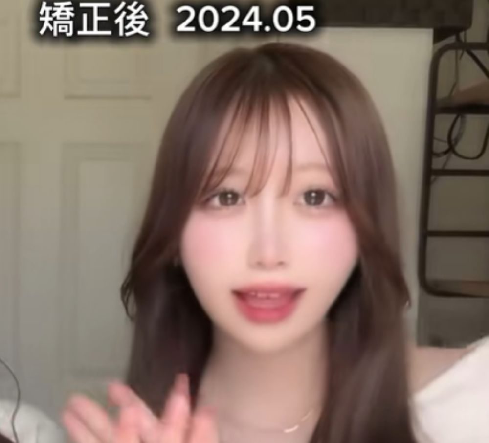 矯正後①（＠_o4.uyu_さんより提供）