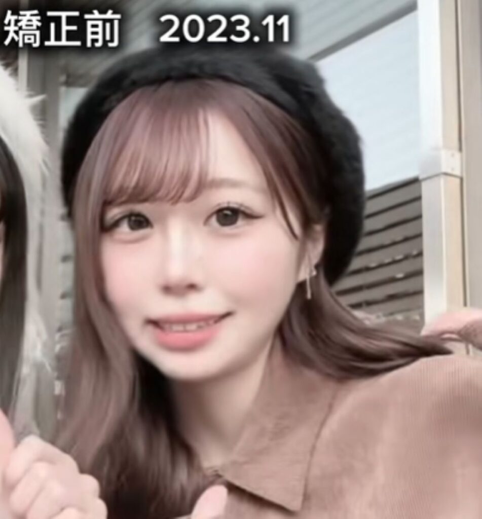 矯正前②（＠_o4.uyu_さんより提供）