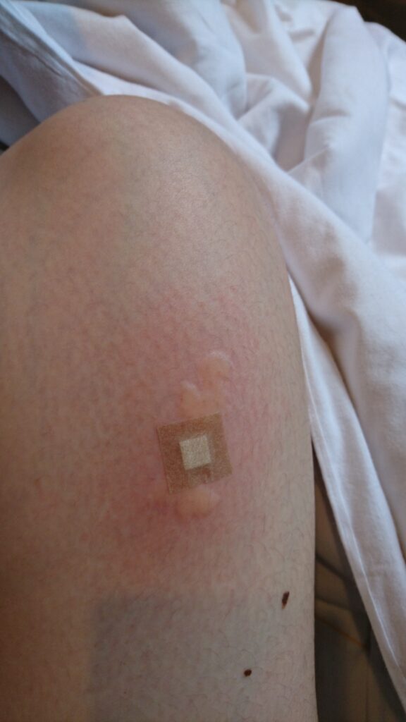 皮下注射（＠mogu_puku.tさんより提供）