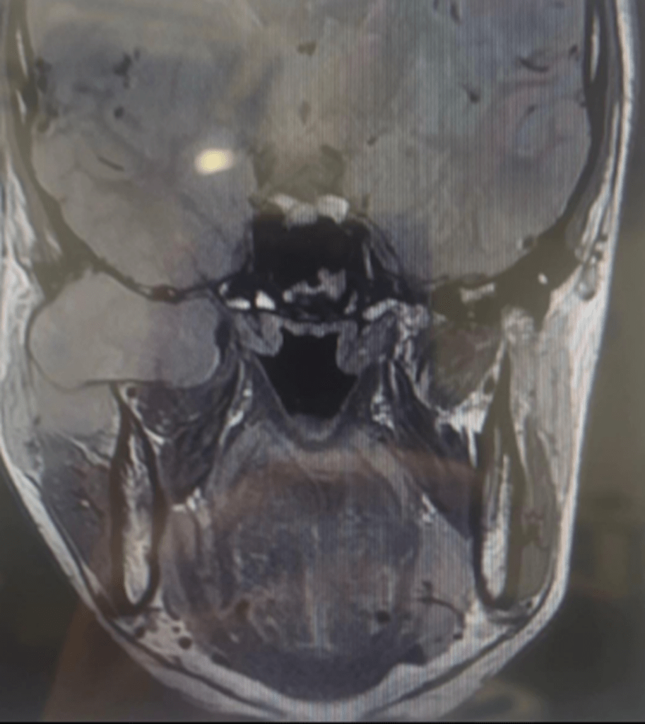【実際の写真】　さらに腫れてしまった顔の様子