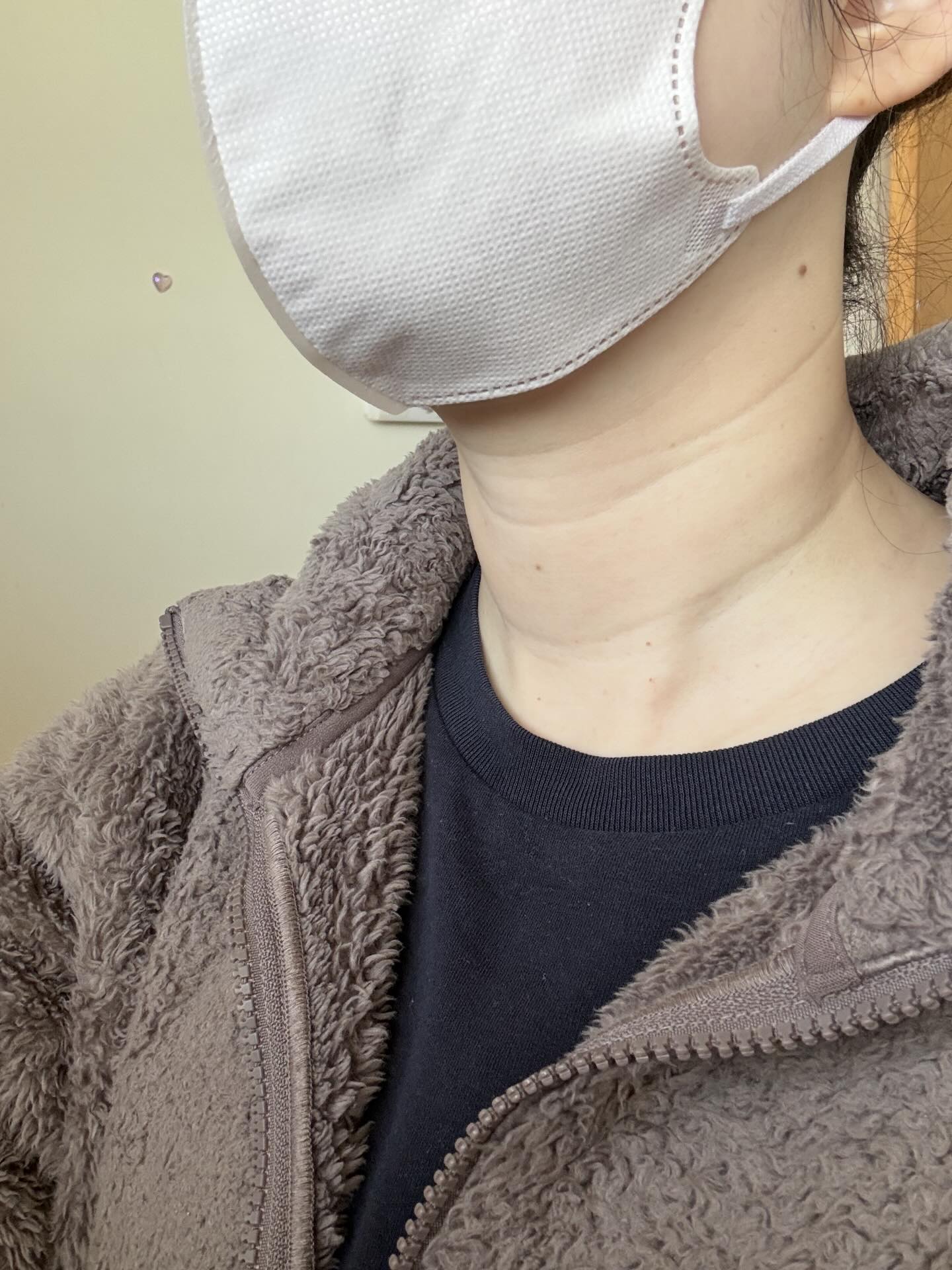 目の痒みに違和感を覚えた女性。→その後、女性の投稿に「それは重症ですね」「どんどん食べなさい」「ツラいよね」