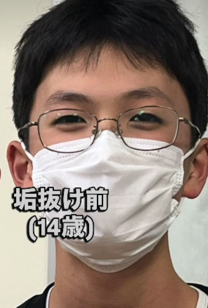 マスク姿の14歳の男の子「ずっとマスクをつけて生活していました」→月日が経ち…現在の驚きの姿に「イケメンすぎる」「切れ長の目、好き」「めっちゃかっこいい」