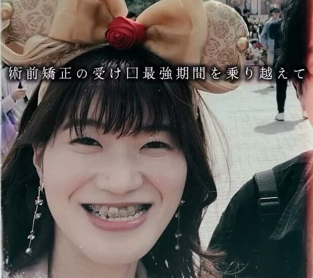 顎変形症の女性「ずっとシャクレに悩んでいた」→しかし、現在の姿に「すごい」「原石だったってことだ」「可愛くなった」
