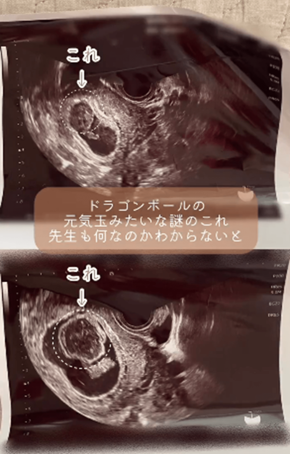 妊婦健診でエコーに違和感…。→その後、医師「流産率50%です」赤ちゃんに判明したまさかの病。当時の母の思いと1年後の現在に迫る