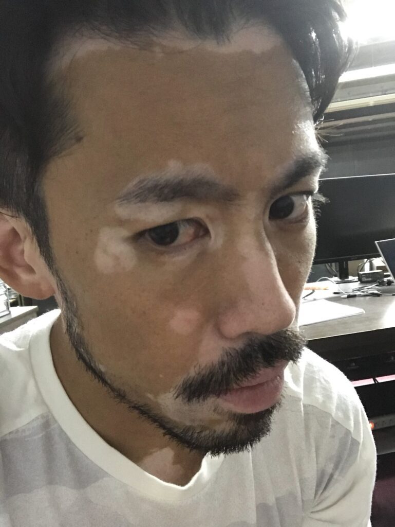 2019年顔の日焼け後（@vitiligo.9286さんより提供）
