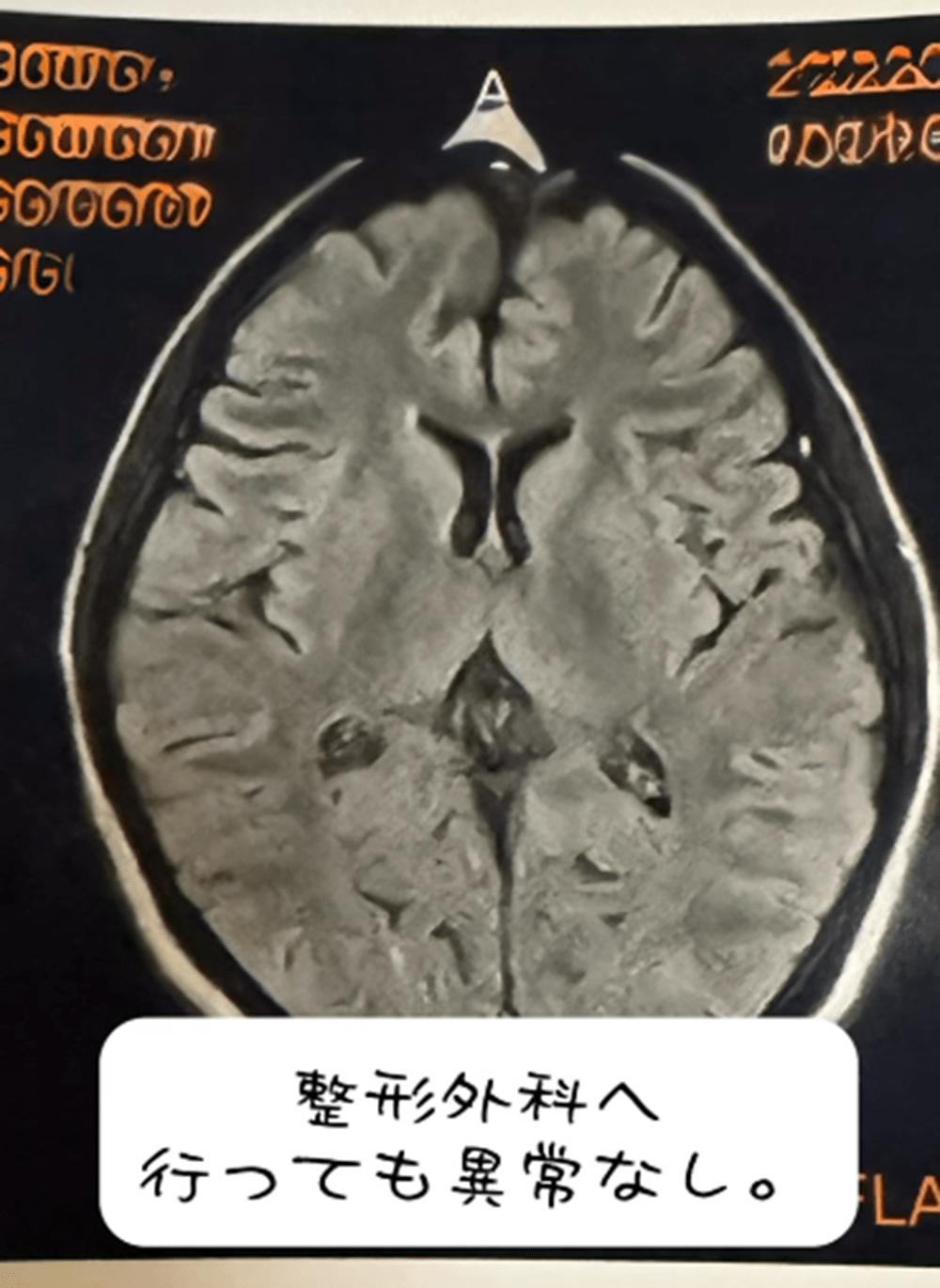 左腕に違和感を覚えた女性「肩こりだろう」→しかしその2ヶ月後…判明した病に「心まで追い詰められていった」　現在の様子に迫る