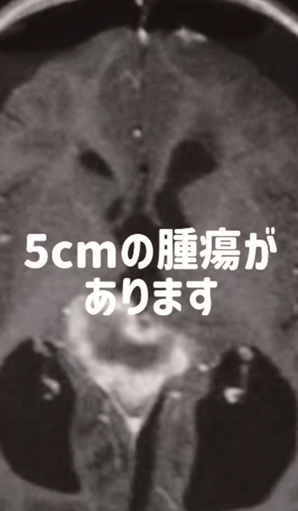 脳に5cmの腫瘍（＠miichan__mamaさんより提供）