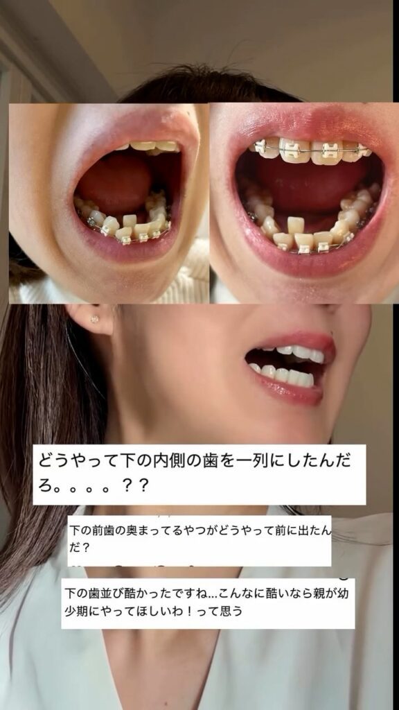 矯正中の様子①（＠nana_beautylife39さんより提供）