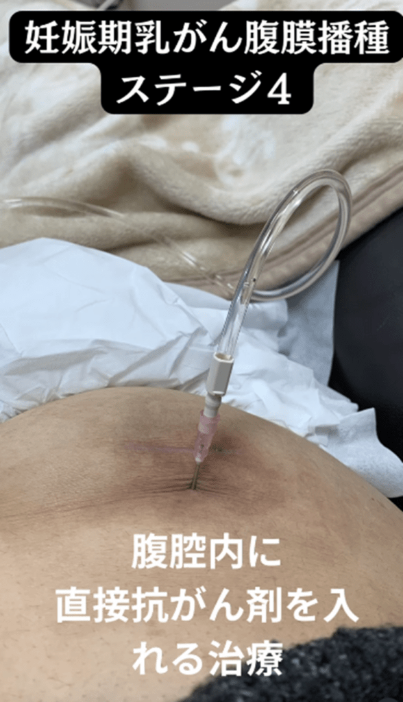 腹腔内化学療法（＠renakinroom.officialさんより提供）