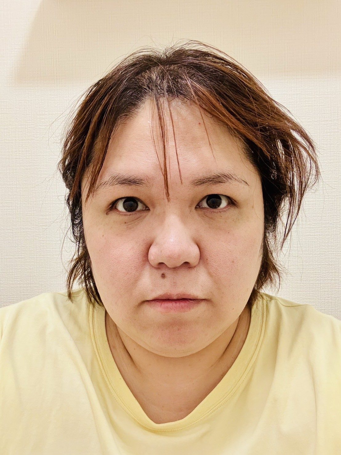 103kgの体重があった女性。しかし「減量が一番の整形」→1年後の“衝撃の姿”に…「別人っっっ」「すげええええ」